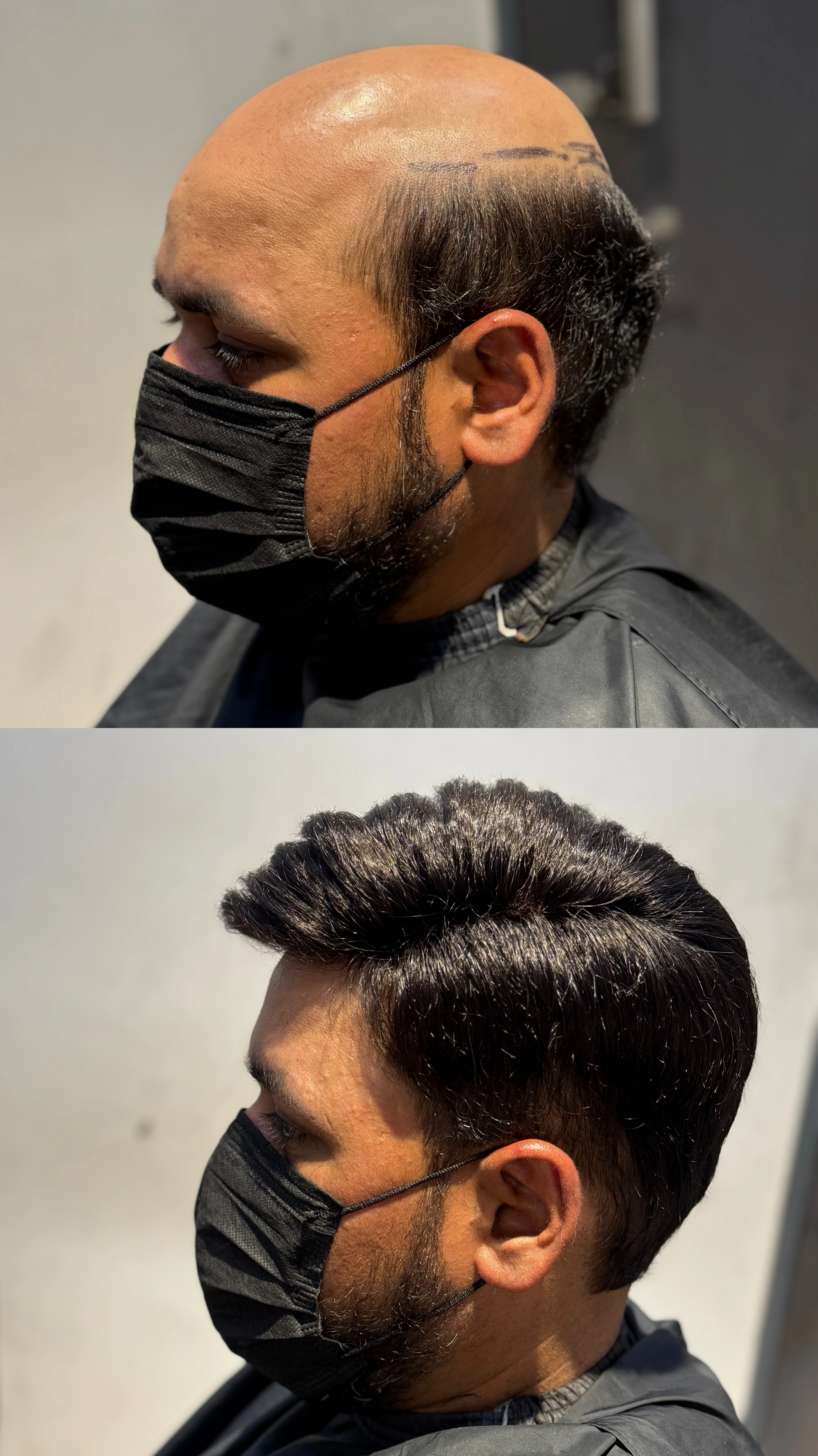 Male Hair Patch