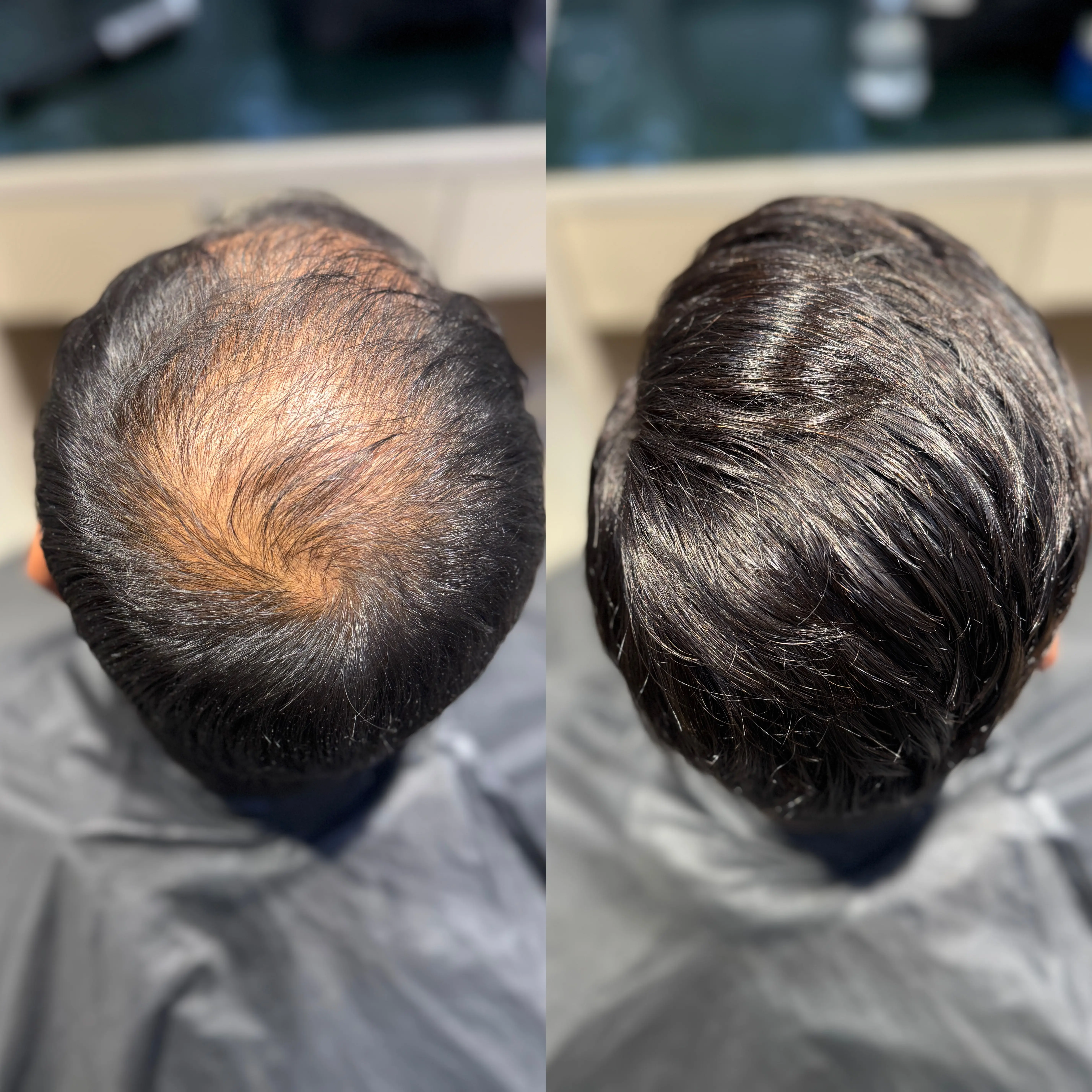 Hair Patch Refixing